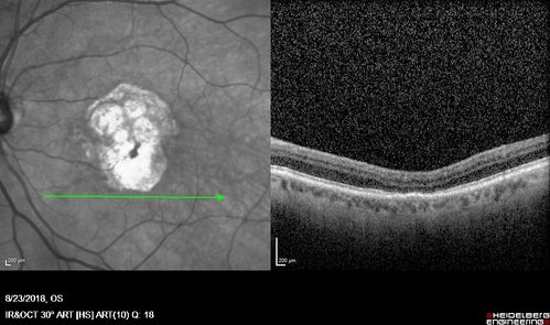 Outer Retinal Tubulation
78 year old man chronic wet AMD - 20/200
