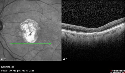 Outer Retinal Tubulation
78 year old man chronic wet AMD - 20/200
