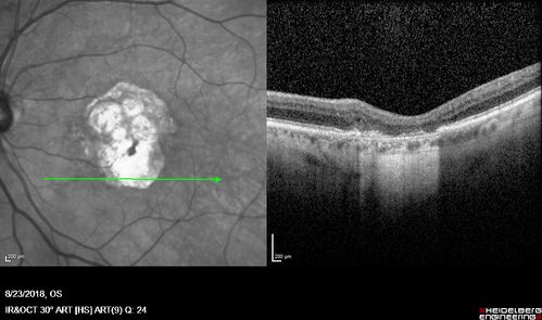 Outer Retinal Tubulation
78 year old man chronic wet AMD - 20/200
