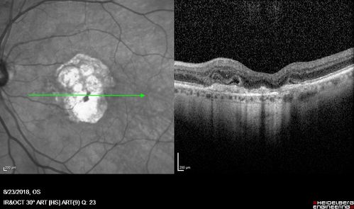 Outer Retinal Tubulation
78 year old man chronic wet AMD - 20/200

