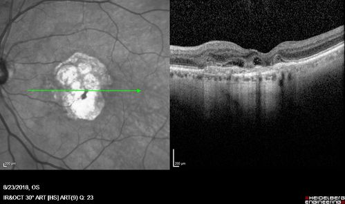 Outer Retinal Tubulation
78 year old man chronic wet AMD - 20/200

