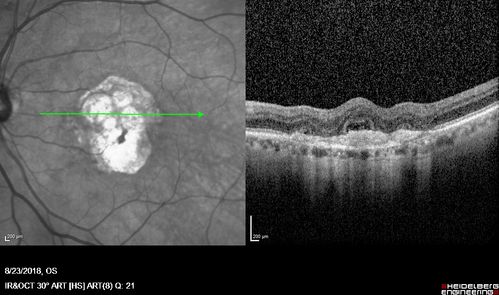 Outer Retinal Tubulation
78 year old man chronic wet AMD - 20/200
