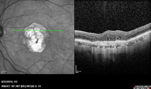 Outer Retinal Tubulation
78 year old man chronic wet AMD - 20/200
