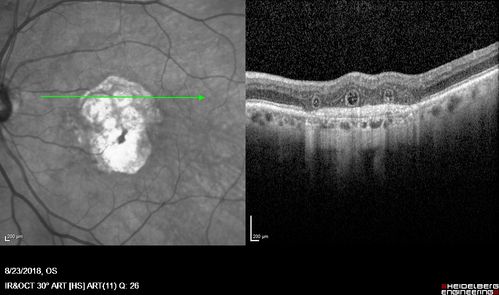 Outer Retinal Tubulation
78 year old man chronic wet AMD - 20/200
