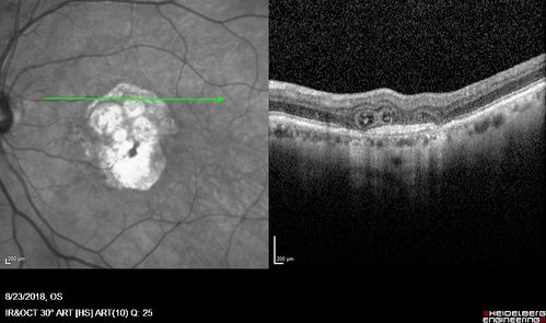 Outer Retinal Tubulation
78 year old man chronic wet AMD - 20/200
