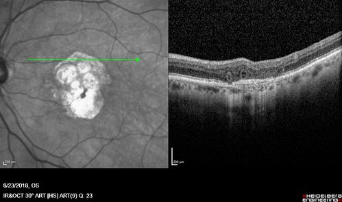 Outer Retinal Tubulation
78 year old man chronic wet AMD - 20/200
