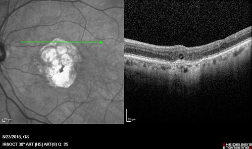 Outer Retinal Tubulation
78 year old man chronic wet AMD - 20/200
