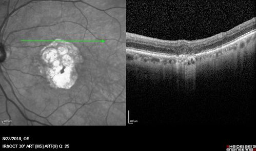 Outer Retinal Tubulation
78 year old man chronic wet AMD - 20/200
