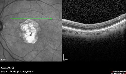 Outer Retinal Tubulation
78 year old man chronic wet AMD - 20/200
