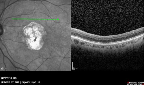 Outer Retinal Tubulation
78 year old man chronic wet AMD - 20/200
