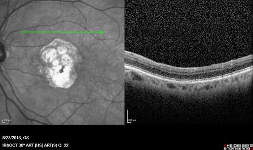 Outer Retinal Tubulation
78 year old man chronic wet AMD - 20/200
