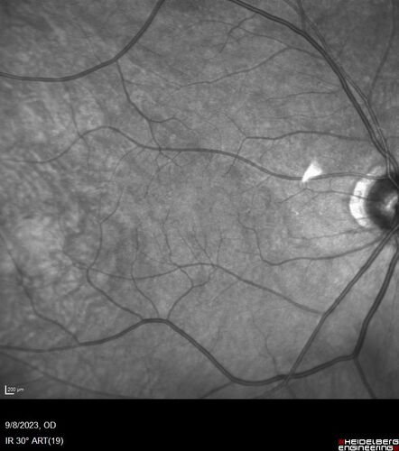 Paracentral acute middle maculopathy - isolated
83 year old man New spot in the vision yesterday left eye.
Medical Hx: Pure Hypercholesterolemia
Systemic Meds: Crestor.
VA OD: Dcc20/20
VA OS: Dcc20/20
IOP: TP: OD:19 OS:10
