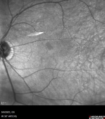 Paracentral acute middle maculopathy - isolated
83 year old man New spot in the vision yesterday left eye.
Medical Hx: Pure Hypercholesterolemia
Systemic Meds: Crestor.
VA OD: Dcc20/20
VA OS: Dcc20/20
IOP: TP: OD:19 OS:10

