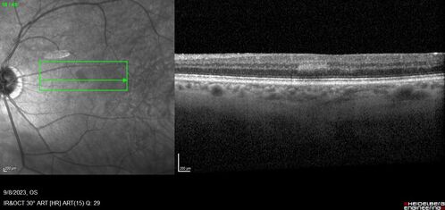 Paracentral acute middle maculopathy - isolated
83 year old man New spot in the vision yesterday left eye.
Medical Hx: Pure Hypercholesterolemia
Systemic Meds: Crestor.
VA OD: Dcc20/20
VA OS: Dcc20/20
IOP: TP: OD:19 OS:10
