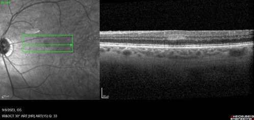 Paracentral acute middle maculopathy - isolated
83 year old man New spot in the vision yesterday left eye.
Medical Hx: Pure Hypercholesterolemia
Systemic Meds: Crestor.
VA OD: Dcc20/20
VA OS: Dcc20/20
IOP: TP: OD:19 OS:10
