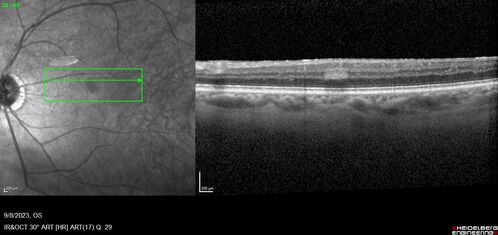 Paracentral acute middle maculopathy - isolated
83 year old man New spot in the vision yesterday left eye.
Medical Hx: Pure Hypercholesterolemia
Systemic Meds: Crestor.
VA OD: Dcc20/20
VA OS: Dcc20/20
IOP: TP: OD:19 OS:10
