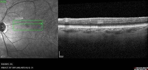 Paracentral acute middle maculopathy - isolated
83 year old man New spot in the vision yesterday left eye.
Medical Hx: Pure Hypercholesterolemia
Systemic Meds: Crestor.
VA OD: Dcc20/20
VA OS: Dcc20/20
IOP: TP: OD:19 OS:10
