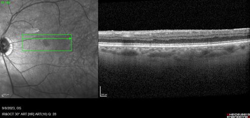 Paracentral acute middle maculopathy - isolated
83 year old man New spot in the vision yesterday left eye.
Medical Hx: Pure Hypercholesterolemia
Systemic Meds: Crestor.
VA OD: Dcc20/20
VA OS: Dcc20/20
IOP: TP: OD:19 OS:10
