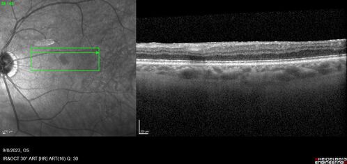 Paracentral acute middle maculopathy - isolated
83 year old man New spot in the vision yesterday left eye.
Medical Hx: Pure Hypercholesterolemia
Systemic Meds: Crestor.
VA OD: Dcc20/20
VA OS: Dcc20/20
IOP: TP: OD:19 OS:10
