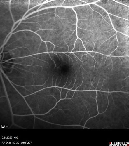 Paracentral acute middle maculopathy - isolated
83 year old man New spot in the vision yesterday left eye.
Medical Hx: Pure Hypercholesterolemia
Systemic Meds: Crestor.
VA OD: Dcc20/20
VA OS: Dcc20/20
IOP: TP: OD:19 OS:10
