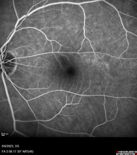 Paracentral acute middle maculopathy - isolated
83 year old man New spot in the vision yesterday left eye.
Medical Hx: Pure Hypercholesterolemia
Systemic Meds: Crestor.
VA OD: Dcc20/20
VA OS: Dcc20/20
IOP: TP: OD:19 OS:10
