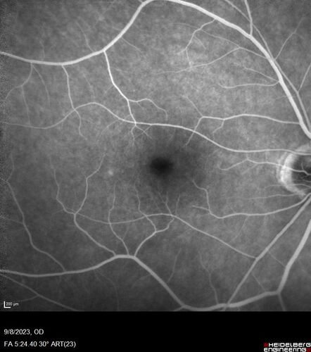 Paracentral acute middle maculopathy - isolated
83 year old man New spot in the vision yesterday left eye.
Medical Hx: Pure Hypercholesterolemia
Systemic Meds: Crestor.
VA OD: Dcc20/20
VA OS: Dcc20/20
IOP: TP: OD:19 OS:10
