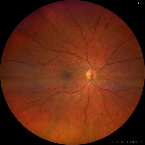 Pregnant - 25 weeks - new onset PDR and DME both eyes - Treated with PRP and ozurdex
29 year old female.  Patient is 25 weeks pregnant and having flare up of retinopathy in both eyes. She states it is worse in the left. Patient has trouble with distant vision.  At most recent visit, 1 years ago, VA was 20/20 OU.  Two years ago anterior uveitis x 1 episode with normal labs (HLAB27, FTA, ACE, Lyme).  2017-2020 â€“ Lucentis for DME left eye only.
PMHx: Type I DM since teenager, hyperlipidemia
BP was normal
