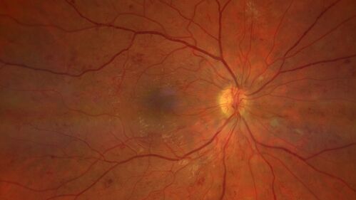 Pregnant - 25 weeks - new onset PDR and DME both eyes - Treated with PRP and ozurdex
29 year old female.  Patient is 25 weeks pregnant and having flare up of retinopathy in both eyes. She states it is worse in the left. Patient has trouble with distant vision.  At most recent visit, 1 years ago, VA was 20/20 OU.  Two years ago anterior uveitis x 1 episode with normal labs (HLAB27, FTA, ACE, Lyme).  2017-2020 â€“ Lucentis for DME left eye only.
PMHx: Type I DM since teenager, hyperlipidemia
BP was normal

