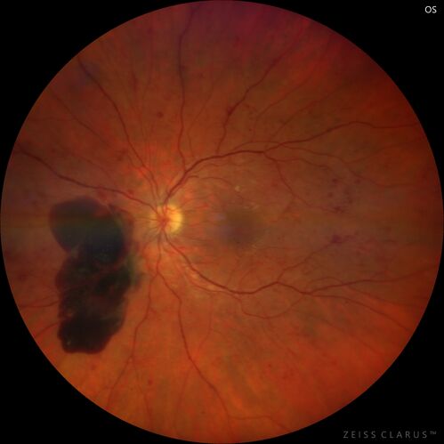 Pregnant - 25 weeks - new onset PDR and DME both eyes - Treated with PRP and ozurdex
29 year old female.  Patient is 25 weeks pregnant and having flare up of retinopathy in both eyes. She states it is worse in the left. Patient has trouble with distant vision.  At most recent visit, 1 years ago, VA was 20/20 OU.  Two years ago anterior uveitis x 1 episode with normal labs (HLAB27, FTA, ACE, Lyme).  2017-2020 â€“ Lucentis for DME left eye only.
PMHx: Type I DM since teenager, hyperlipidemia
BP was normal
