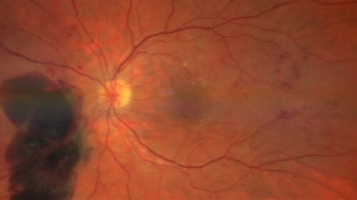 Pregnant - 25 weeks - new onset PDR and DME both eyes - Treated with PRP and ozurdex
29 year old female.  Patient is 25 weeks pregnant and having flare up of retinopathy in both eyes. She states it is worse in the left. Patient has trouble with distant vision.  At most recent visit, 1 years ago, VA was 20/20 OU.  Two years ago anterior uveitis x 1 episode with normal labs (HLAB27, FTA, ACE, Lyme).  2017-2020 â€“ Lucentis for DME left eye only.
PMHx: Type I DM since teenager, hyperlipidemia
BP was normal
