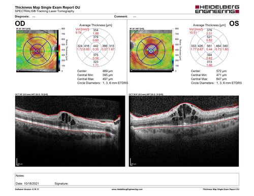 Pregnant - 25 weeks - new onset PDR and DME both eyes - Treated with PRP and ozurdex
29 year old female.  Patient is 25 weeks pregnant and having flare up of retinopathy in both eyes. She states it is worse in the left. Patient has trouble with distant vision.  At most recent visit, 1 years ago, VA was 20/20 OU.  Two years ago anterior uveitis x 1 episode with normal labs (HLAB27, FTA, ACE, Lyme).  2017-2020 â€“ Lucentis for DME left eye only.
PMHx: Type I DM since teenager, hyperlipidemia
BP was normal
