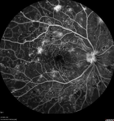 Pregnant - 25 weeks - new onset PDR and DME both eyes - Treated with PRP and ozurdex
29 year old female.  Patient is 25 weeks pregnant and having flare up of retinopathy in both eyes. She states it is worse in the left. Patient has trouble with distant vision.  At most recent visit, 1 years ago, VA was 20/20 OU.  Two years ago anterior uveitis x 1 episode with normal labs (HLAB27, FTA, ACE, Lyme).  2017-2020 â€“ Lucentis for DME left eye only.
PMHx: Type I DM since teenager, hyperlipidemia
BP was normal
