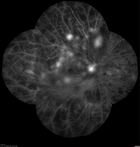 Pregnant - 25 weeks - new onset PDR and DME both eyes - Treated with PRP and ozurdex
29 year old female.  Patient is 25 weeks pregnant and having flare up of retinopathy in both eyes. She states it is worse in the left. Patient has trouble with distant vision.  At most recent visit, 1 years ago, VA was 20/20 OU.  Two years ago anterior uveitis x 1 episode with normal labs (HLAB27, FTA, ACE, Lyme).  2017-2020 â€“ Lucentis for DME left eye only.
PMHx: Type I DM since teenager, hyperlipidemia
BP was normal
