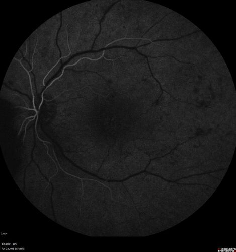 Pregnant - 25 weeks - new onset PDR and DME both eyes - Treated with PRP and ozurdex
29 year old female.  Patient is 25 weeks pregnant and having flare up of retinopathy in both eyes. She states it is worse in the left. Patient has trouble with distant vision.  At most recent visit, 1 years ago, VA was 20/20 OU.  Two years ago anterior uveitis x 1 episode with normal labs (HLAB27, FTA, ACE, Lyme).  2017-2020 â€“ Lucentis for DME left eye only.
PMHx: Type I DM since teenager, hyperlipidemia
BP was normal
