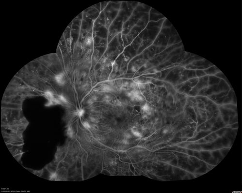 Pregnant - 25 weeks - new onset PDR and DME both eyes - Treated with PRP and ozurdex
29 year old female.  Patient is 25 weeks pregnant and having flare up of retinopathy in both eyes. She states it is worse in the left. Patient has trouble with distant vision.  At most recent visit, 1 years ago, VA was 20/20 OU.  Two years ago anterior uveitis x 1 episode with normal labs (HLAB27, FTA, ACE, Lyme).  2017-2020 â€“ Lucentis for DME left eye only.
PMHx: Type I DM since teenager, hyperlipidemia
BP was normal
