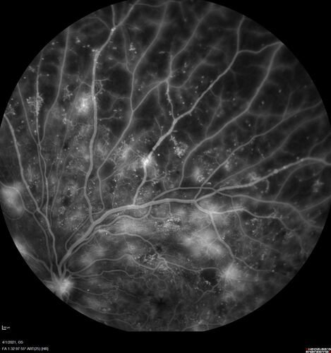 Pregnant - 25 weeks - new onset PDR and DME both eyes - Treated with PRP and ozurdex
29 year old female.  Patient is 25 weeks pregnant and having flare up of retinopathy in both eyes. She states it is worse in the left. Patient has trouble with distant vision.  At most recent visit, 1 years ago, VA was 20/20 OU.  Two years ago anterior uveitis x 1 episode with normal labs (HLAB27, FTA, ACE, Lyme).  2017-2020 â€“ Lucentis for DME left eye only.
PMHx: Type I DM since teenager, hyperlipidemia
BP was normal
