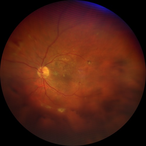 PDR and DME and VH
57 year old diabetic man with vision loss in the left eye for several months.  He has DME in the left eye and VH in the left eye and PDR in both eyes.  He has been started in the left eye on Anti-VEGF therapy. VA on presentation was 20/25 OD and 20/200 OS
