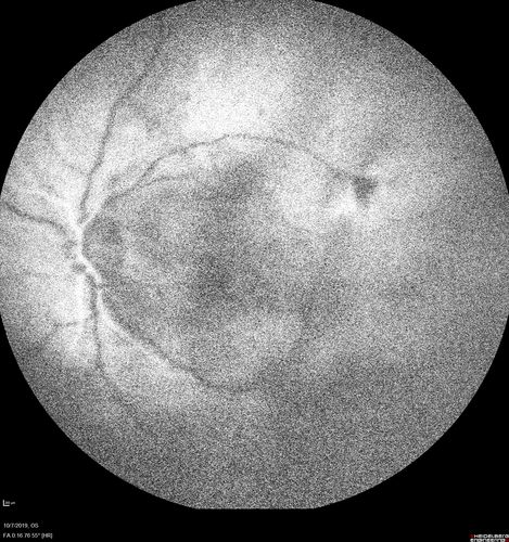 PDR and DME and VH
57 year old diabetic man with vision loss in the left eye for several months.  He has DME in the left eye and VH in the left eye and PDR in both eyes.  He has been started in the left eye on Anti-VEGF therapy. VA on presentation was 20/25 OD and 20/200 OS
