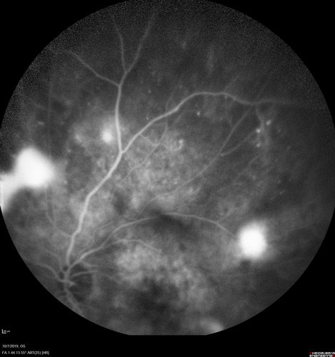 PDR and DME and VH
57 year old diabetic man with vision loss in the left eye for several months.  He has DME in the left eye and VH in the left eye and PDR in both eyes.  He has been started in the left eye on Anti-VEGF therapy. VA on presentation was 20/25 OD and 20/200 OS
