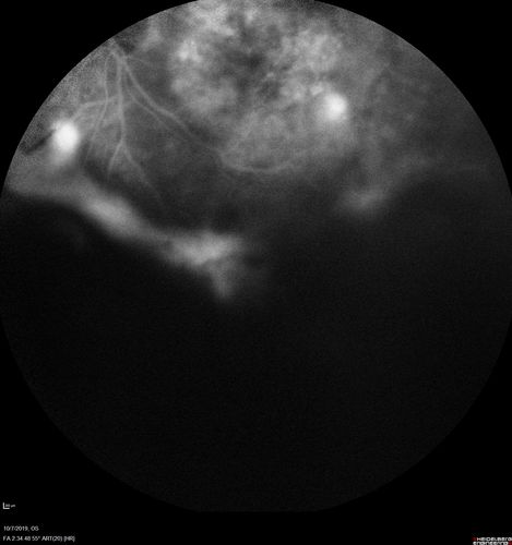 PDR and DME and VH
57 year old diabetic man with vision loss in the left eye for several months.  He has DME in the left eye and VH in the left eye and PDR in both eyes.  He has been started in the left eye on Anti-VEGF therapy. VA on presentation was 20/25 OD and 20/200 OS
