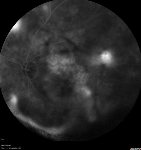 PDR and DME and VH
57 year old diabetic man with vision loss in the left eye for several months.  He has DME in the left eye and VH in the left eye and PDR in both eyes.  He has been started in the left eye on Anti-VEGF therapy. VA on presentation was 20/25 OD and 20/200 OS
