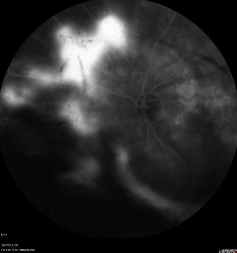 PDR and DME and VH
57 year old diabetic man with vision loss in the left eye for several months.  He has DME in the left eye and VH in the left eye and PDR in both eyes.  He has been started in the left eye on Anti-VEGF therapy. VA on presentation was 20/25 OD and 20/200 OS
