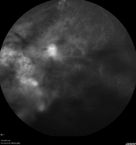 PDR and DME and VH
57 year old diabetic man with vision loss in the left eye for several months.  He has DME in the left eye and VH in the left eye and PDR in both eyes.  He has been started in the left eye on Anti-VEGF therapy. VA on presentation was 20/25 OD and 20/200 OS
