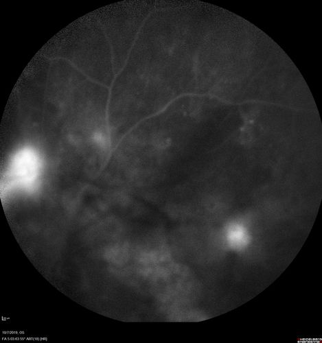PDR and DME and VH
57 year old diabetic man with vision loss in the left eye for several months.  He has DME in the left eye and VH in the left eye and PDR in both eyes.  He has been started in the left eye on Anti-VEGF therapy. VA on presentation was 20/25 OD and 20/200 OS
