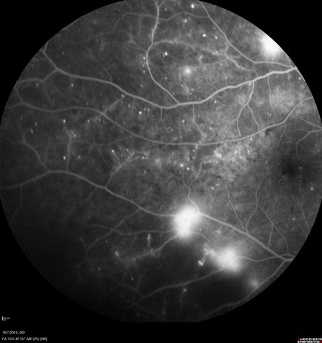 PDR and DME and VH
57 year old diabetic man with vision loss in the left eye for several months.  He has DME in the left eye and VH in the left eye and PDR in both eyes.  He has been started in the left eye on Anti-VEGF therapy. VA on presentation was 20/25 OD and 20/200 OS
