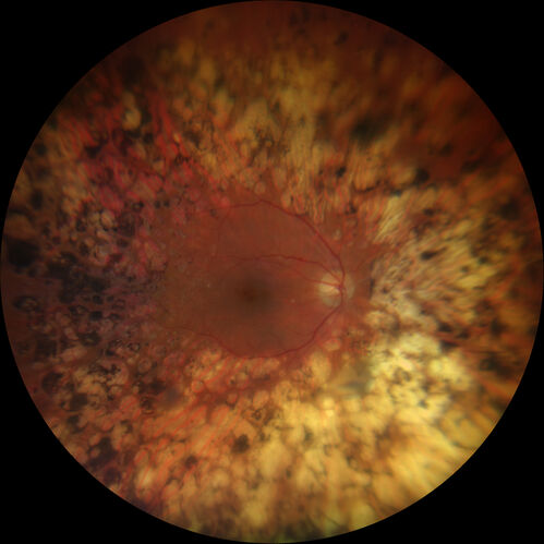 Proliferative Diabetic Retinopathy with Panretinal Photocoagulation
57 year old female Type 1 DM with prior laser about 10 years ago in Chicago.
HTN, Thyroid cancer and removal, Cardiovascular disease
Meds: ASA 325 mg /day, etc
Recent new floaters in the right eye:

VA 20/50 OD, 20/40 OS
