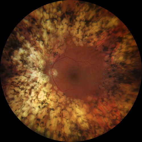 Proliferative Diabetic Retinopathy with Panretinal Photocoagulation
57 year old female Type 1 DM with prior laser about 10 years ago in Chicago.
HTN, Thyroid cancer and removal, Cardiovascular disease
Meds: ASA 325 mg /day, etc
Recent new floaters in the right eye:

VA 20/50 OD, 20/40 OS
