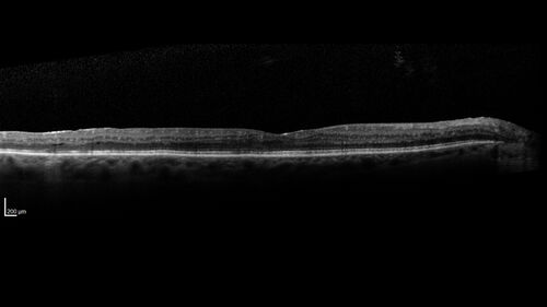 Proliferative Diabetic Retinopathy with Panretinal Photocoagulation
57 year old female Type 1 DM with prior laser about 10 years ago in Chicago.
HTN, Thyroid cancer and removal, Cardiovascular disease
Meds: ASA 325 mg /day, etc
Recent new floaters in the right eye:

VA 20/50 OD, 20/40 OS
