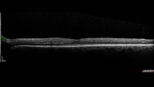 Proliferative Diabetic Retinopathy with Panretinal Photocoagulation
57 year old female Type 1 DM with prior laser about 10 years ago in Chicago.
HTN, Thyroid cancer and removal, Cardiovascular disease
Meds: ASA 325 mg /day, etc
Recent new floaters in the right eye:

VA 20/50 OD, 20/40 OS
