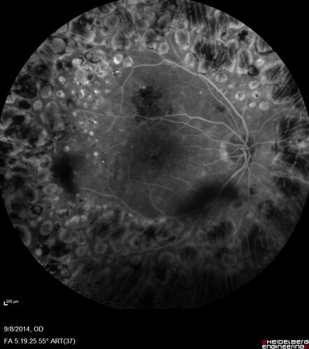 Proliferative Diabetic Retinopathy with Panretinal Photocoagulation
57 year old female Type 1 DM with prior laser about 10 years ago in Chicago.
HTN, Thyroid cancer and removal, Cardiovascular disease
Meds: ASA 325 mg /day, etc
Recent new floaters in the right eye:

VA 20/50 OD, 20/40 OS

